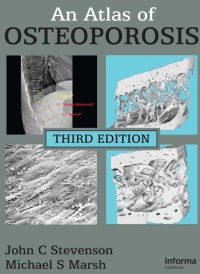 An Atlas of OSTEOPOROSIS