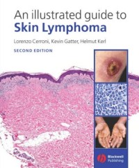 An illustrated guide to Skin Lymphoma